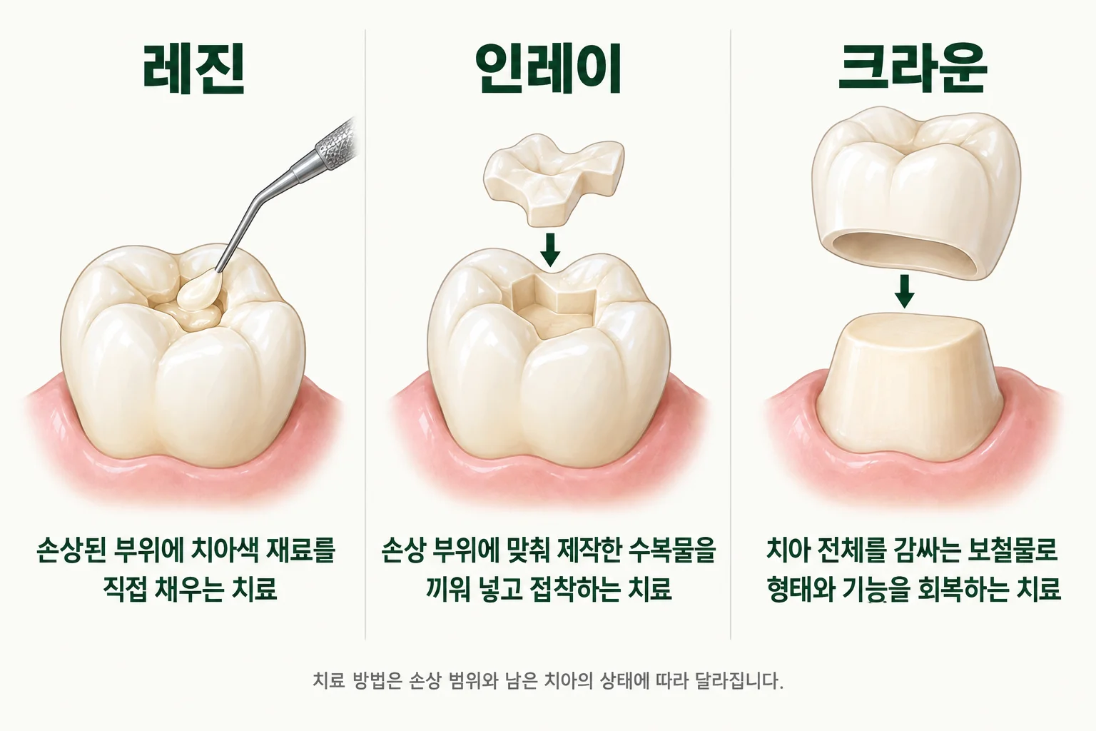레진, 인레이, 크라운의 수복 방법 비교 삽화