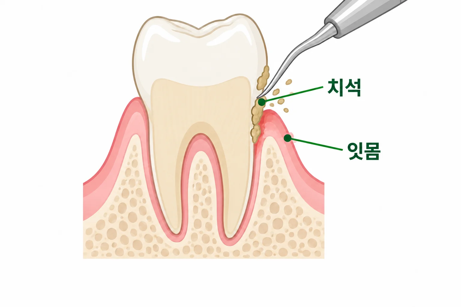 치아 표면과 잇몸 경계의 치석을 제거하는 스케일링 설명 삽화