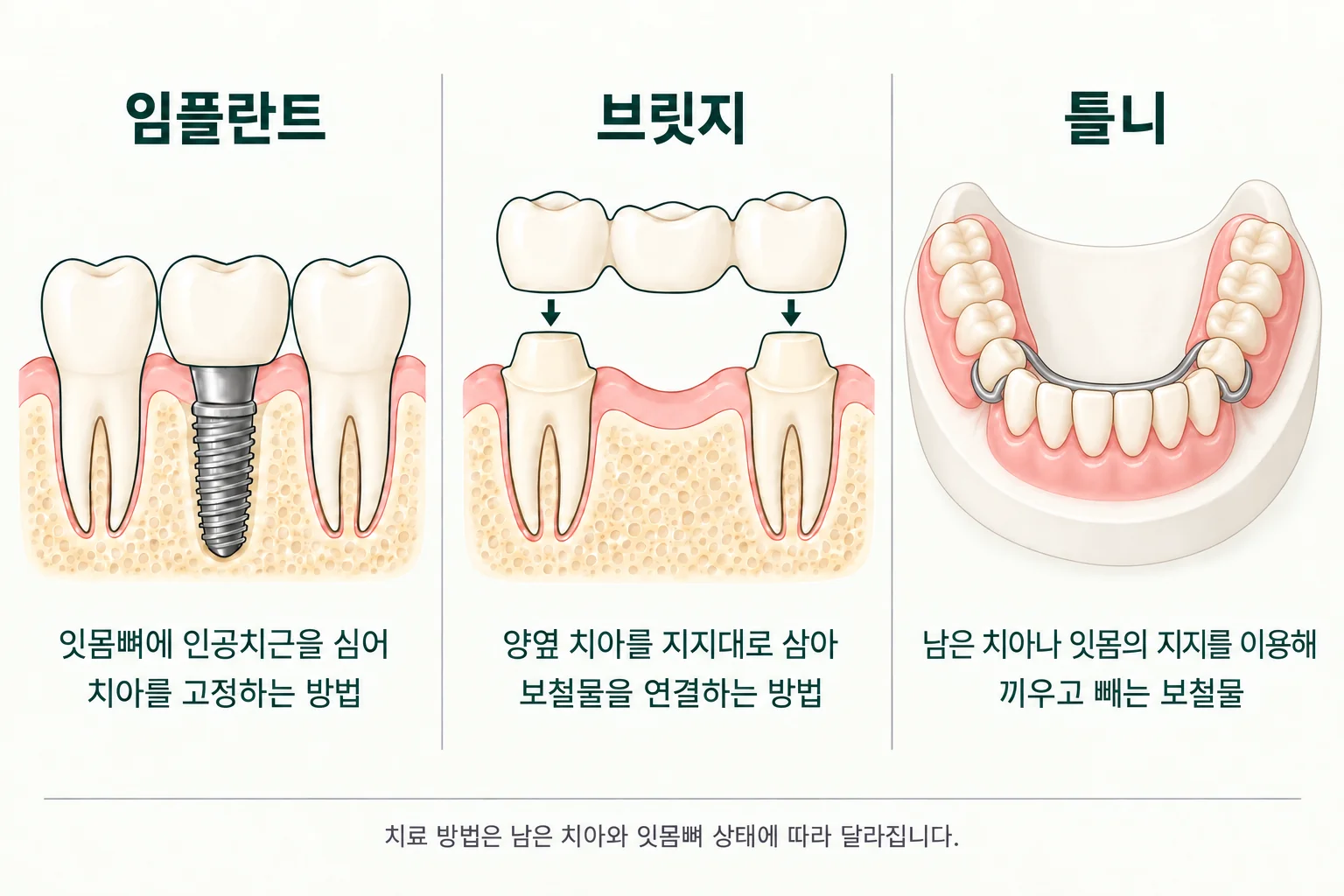 임플란트는 잇몸뼈에 인공치근을 심어 고정하고, 브릿지는 양옆 치아를 지지대로 연결하며, 틀니는 남은 치아나 잇몸의 지지를 이용하는 탈착식 보철물입니다.