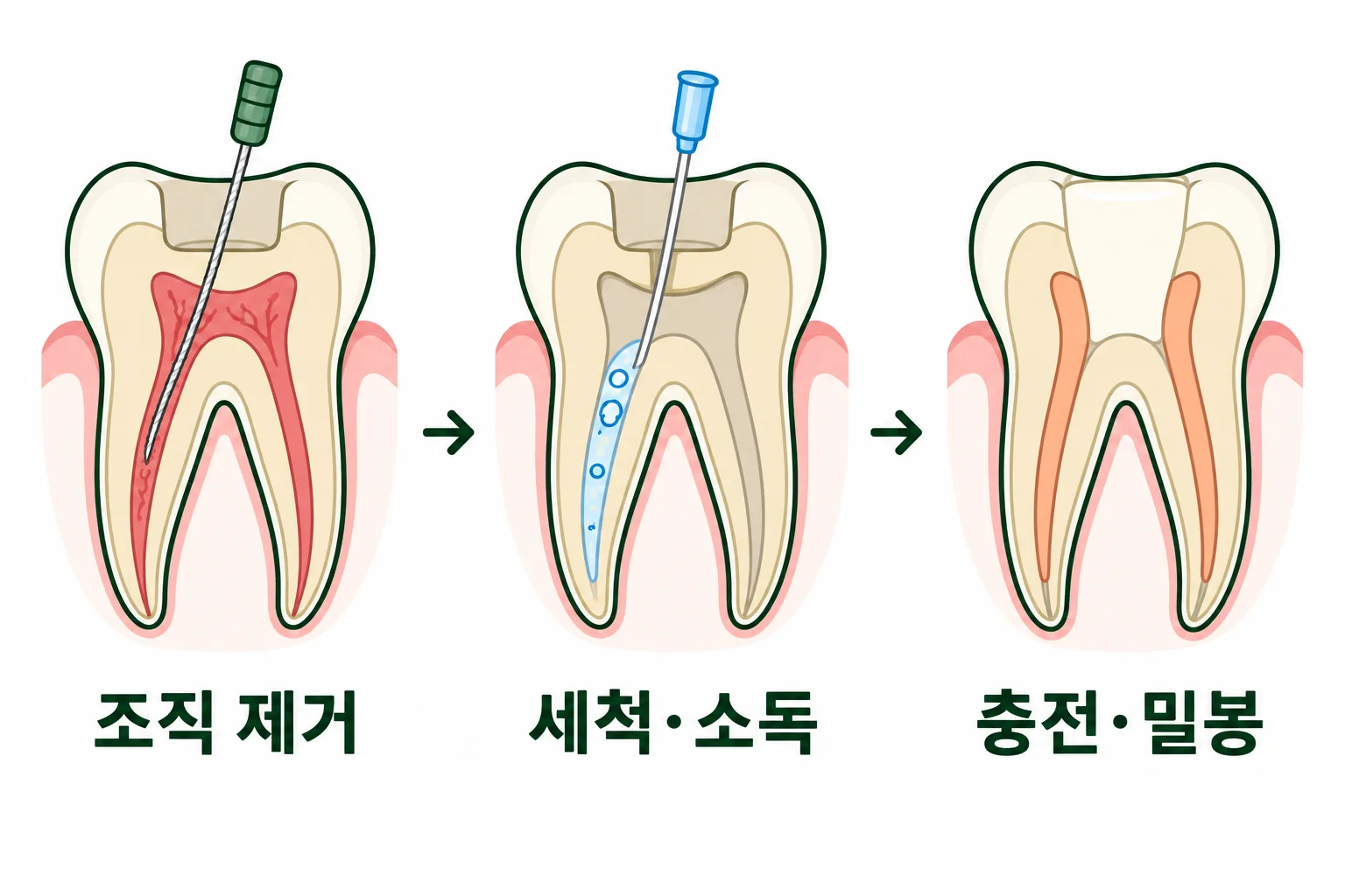 신경치료 과정: 감염된 조직 제거, 근관 세척과 소독, 충전과 밀봉