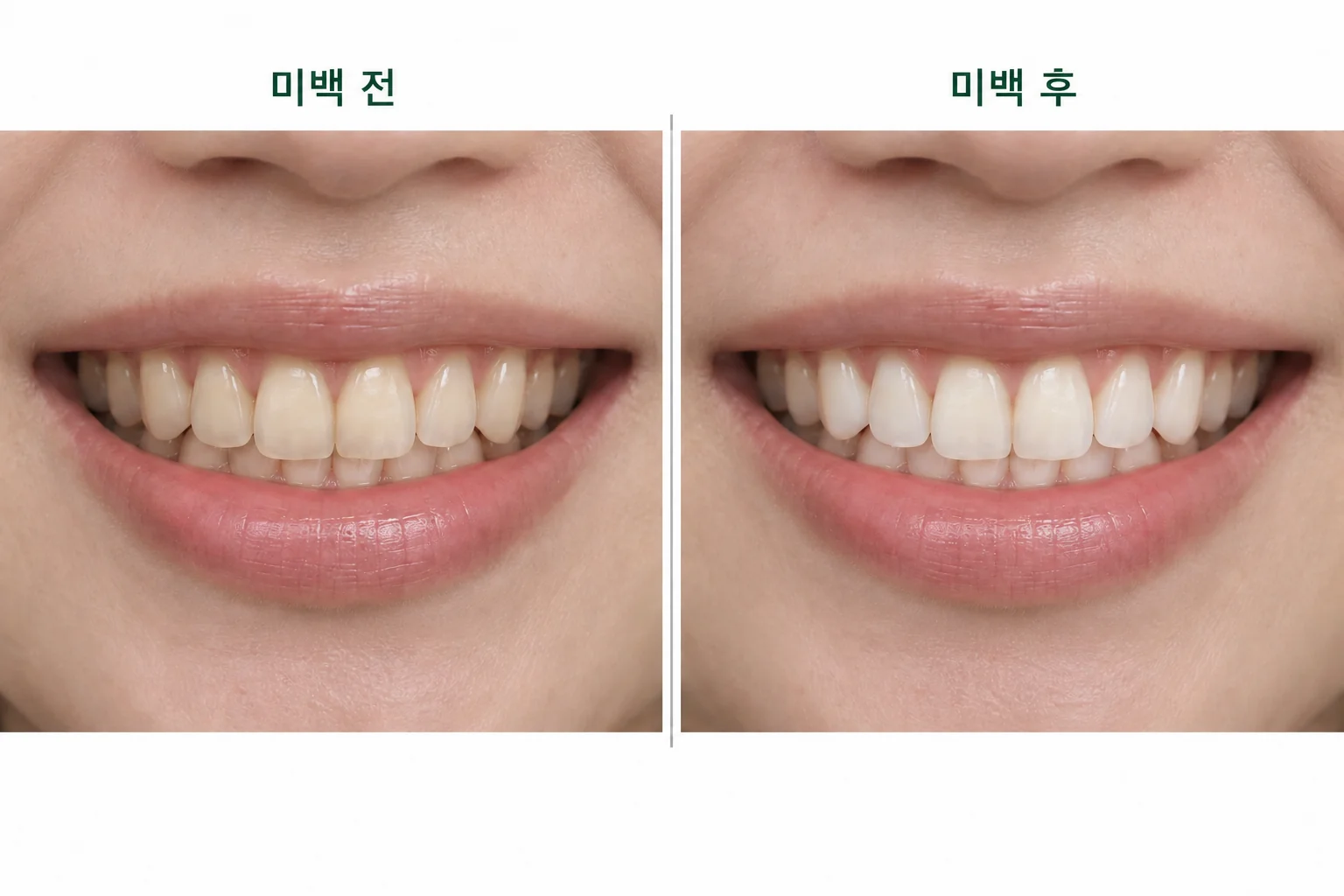 미백 전후 치아 색 변화의 이해를 돕는 가상 비교 이미지